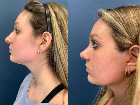 nose shaper results|Rhinoplasty .
